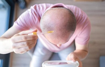 What is the Best Natural Hair Loss Treatment in Georgia?