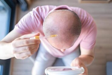 What is the Best Natural Hair Loss Treatment in Georgia?