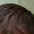 How to stop hair loss while on GLP-1?