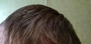 How to stop hair loss while on GLP-1?