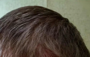 How to stop hair loss while on GLP-1?