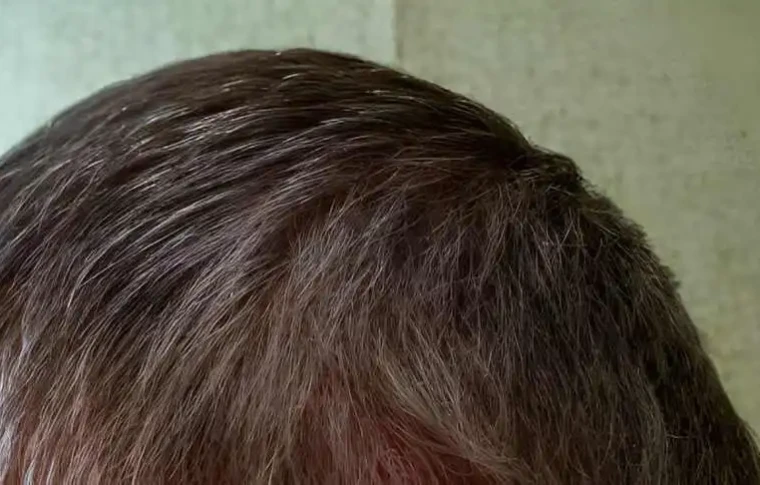 How to stop hair loss while on GLP-1?